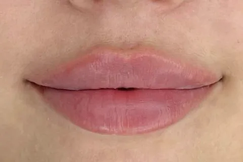 Front view of natural, matte lips after filler at Laser One