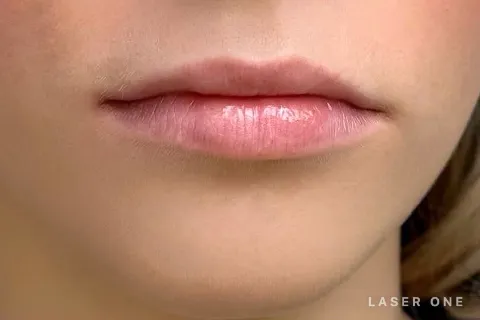 Front view of the same patient's lips before lip filler