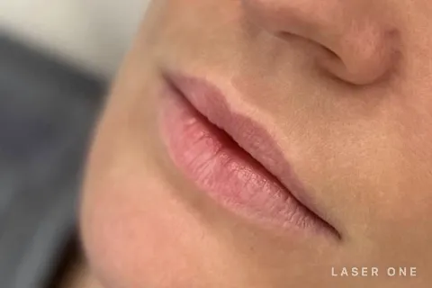 Lips before lip filler, side angle
