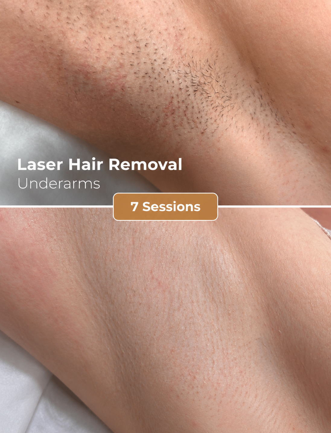 Laser Hair Removal · Underarms 7