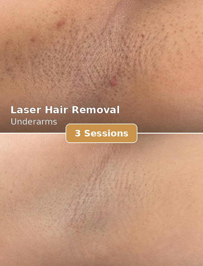 Laser Hair Removal — Underarms 3 Sessions