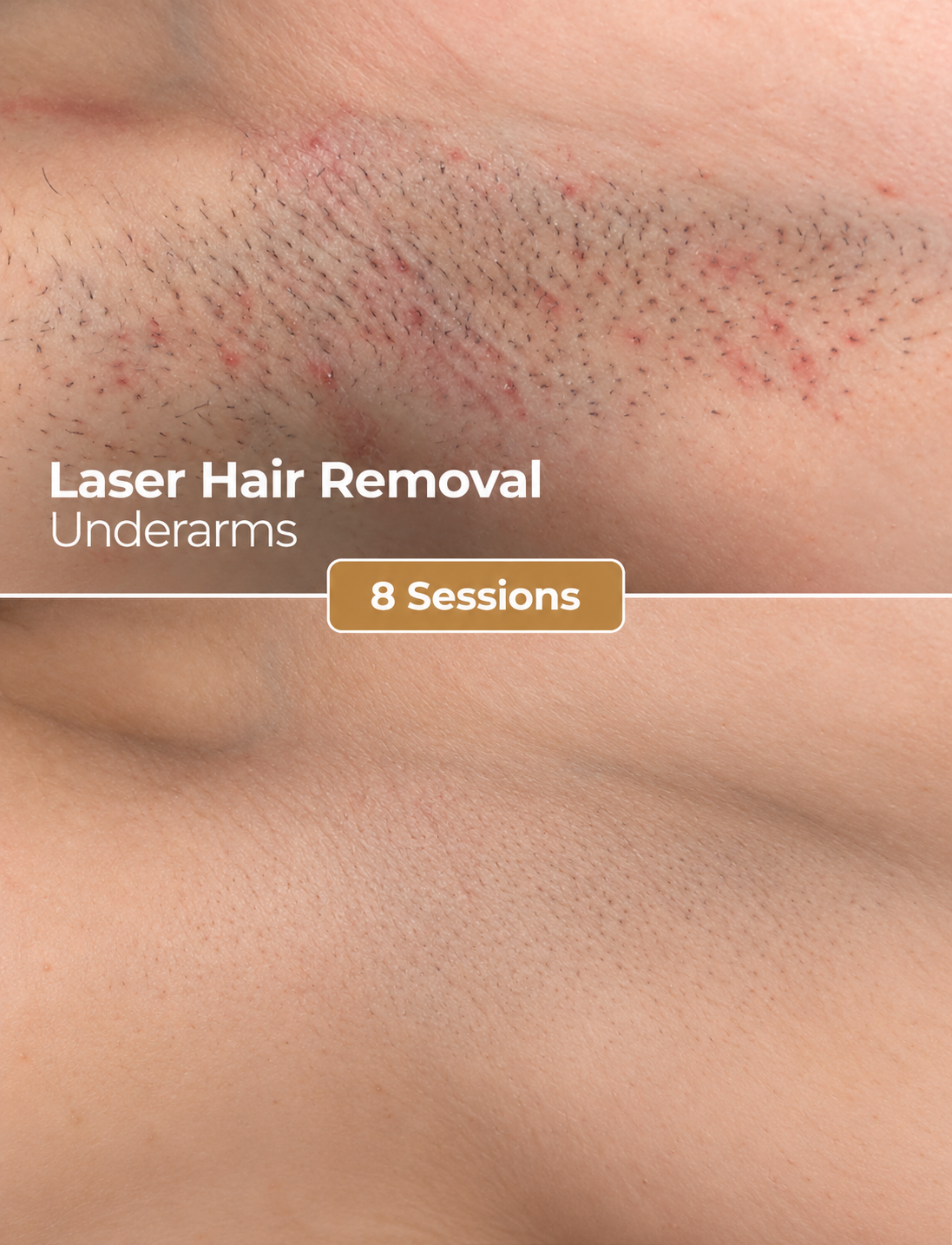 Laser hair removal underarms before and after 8 sessions at Laser One Clinic Dubai