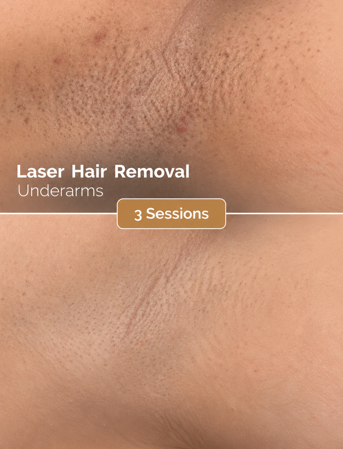 laser_one_legs_3_sessions_650x850