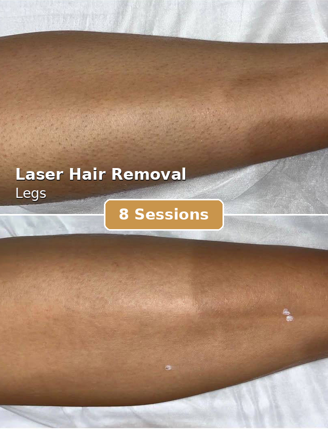 laser_one_legs_8_sessions_650x850